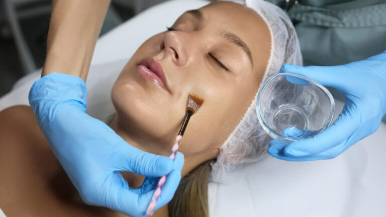 Chemical Peel Washington DC