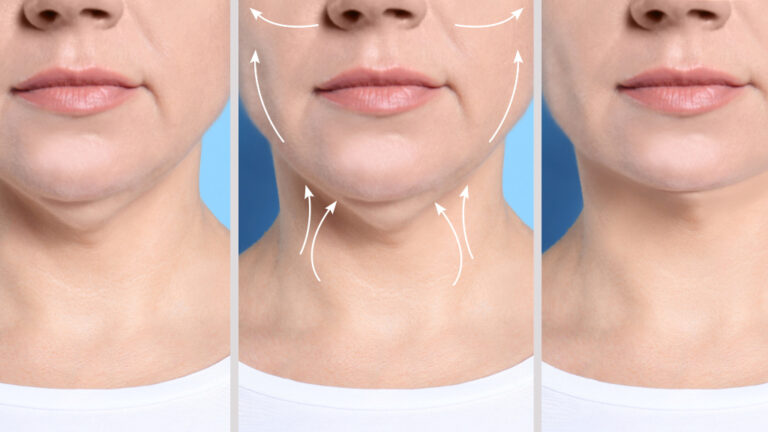 kybella double chin washington dc