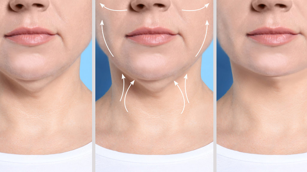 kybella double chin washington dc