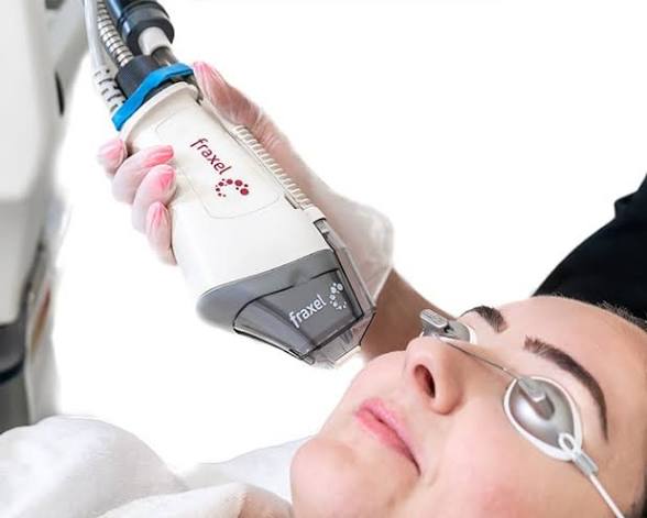 Fraxel , fractional co2 , washington dc, dupont circle, medical cosmetic, dr drew varano, washington dc near Dupont Circle and Georgetown, laser resurfacing, acne scars, and wrinkles