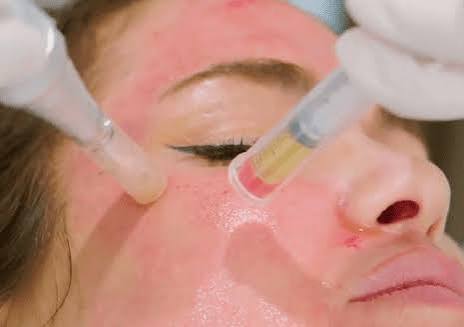 RF microneedling with Collagen induction therapy with Morpheus 8 w, Medical Cosmetic for acne scars, tighten skin, under eyes, see us in Georgetown, Dupont circle, Bethesda Maryland, Arlington Virginia, washington dc, Medical Cosmetic
