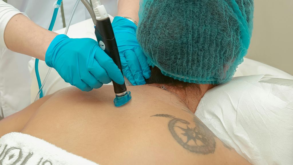 Laser Tattoo Removal