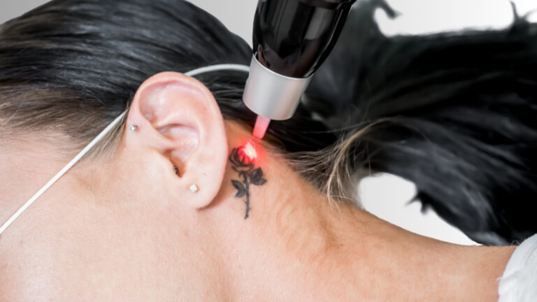 laser tattoo removal washington dc , Georgetown and Dupont Circle