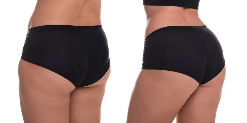 Liposuction Washington DC