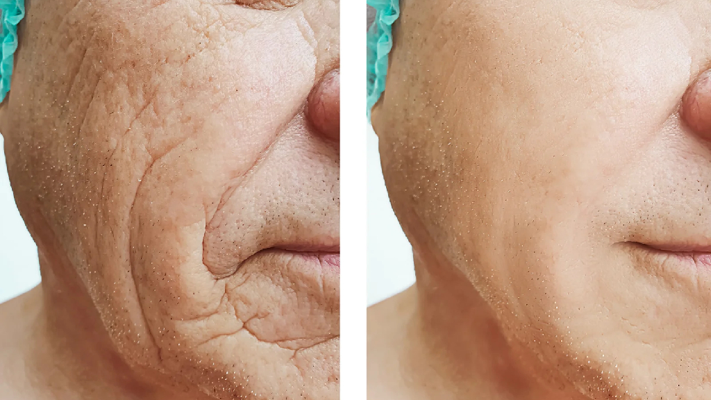 Dysport vs. Botox