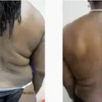 Back Lipo Results Washington DC, Dupont Circle, Georgetown, Arlington Virginia-Dr. Drew Varano