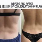 Before and after Coolsculpting treatment by Medical Cosmetic Enhancements in Washington DC