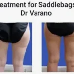 Coolsculpting Thighs Results Washington DC- Medical Cosmetic Enhancements