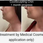 Coolsculpting Results Double chin Washington DC- Medical Cosmetic Enhancements