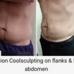 Coolsculpting Results Washington DC- Medical Cosmetic Enhancements
