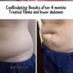 Coolsculpting Results 1 session Washington DC- Medical Cosmetic Enhancements