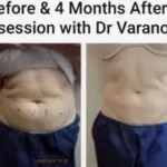 Coolsculpting female abdomen Results Washington DC- Medical Cosmetic Enhancements