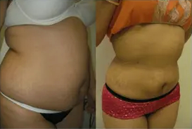 Liposuction Abdomen (women)