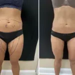Liposuction Abdomen (women)