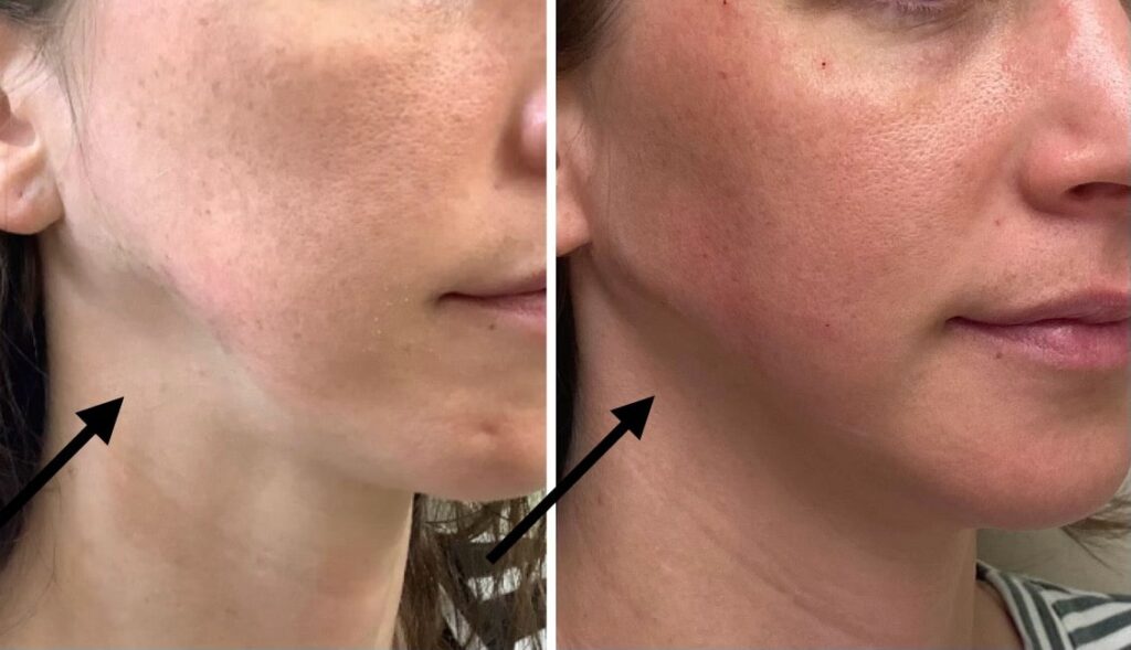 Jawline filler