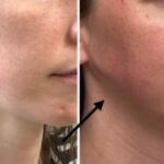 Jawline filler