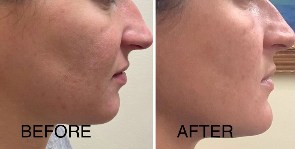 chin filler Washington DC Georgetown Medical Cosmetic