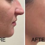 chin filler Washington DC Georgetown Medical Cosmetic