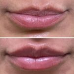 Lip Filler Washington DC Medical Cosmetic