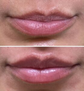 Lip Filler Washington DC Medical Cosmetic