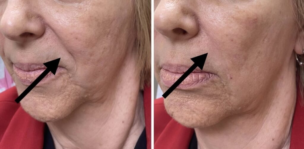 Nasolabial fold and cheeks
