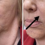 Nasolabial fold and cheeks