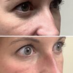 Tear trough filler