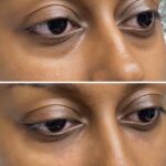 Tear trough filler
