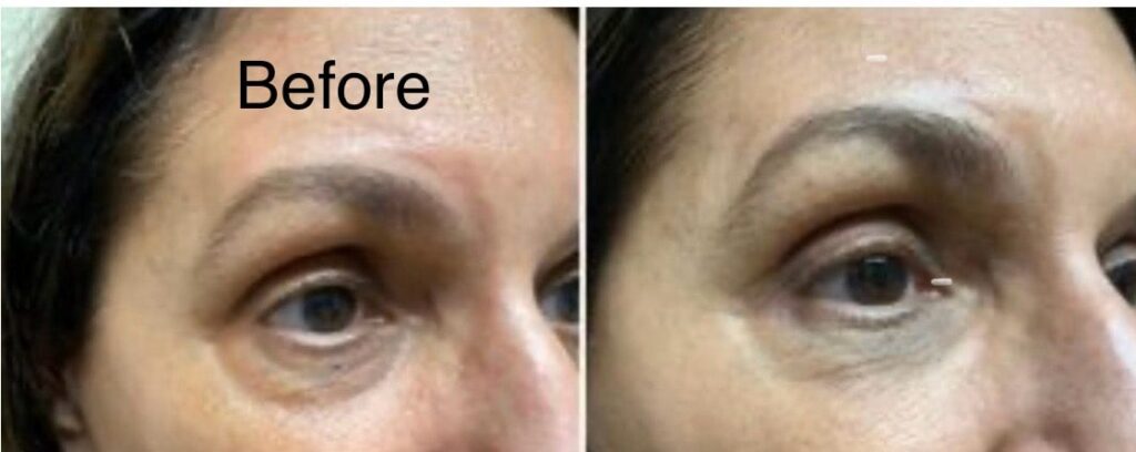 Tear trough filler