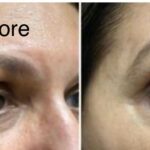 Tear trough filler