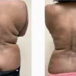 Back Lipo Results Washington DC, Dupont Circle, Georgetown, Arlington Virginia-Dr. Drew Varano