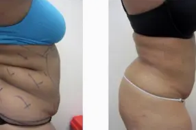 Liposuction Abdomen (women)