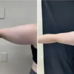 Arm Liposuction Results Washington DC, near Dupont Circle and Georgetown-Dr. Drew Varano