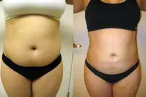 Liposuction Abdomen (women)