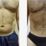 Liposuction Male Results Washington DC- Dr Drew Varano