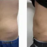 Liposuction Male Results Washington DC- Medical Cosmetic Enhancements