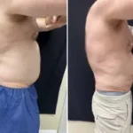 Liposuction Male Results Washington DC- Medical Cosmetic Enhancements