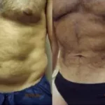 Liposuction Male Results Washington DC- Medical Cosmetic Enhancements