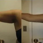 Arm Liposuction at 4 days Results Washington DC-Dr. Drew Varano