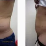 Liposuction Male Results Washington DC- Dr. Drew Varano