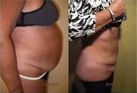 Liposuction Abdomen (women)