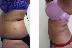 Liposuction Abdomen (women)