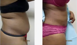 Liposuction Abdomen (women)