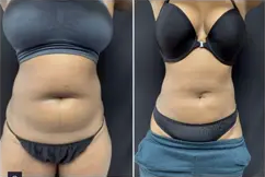 Liposuction Abdomen (women)