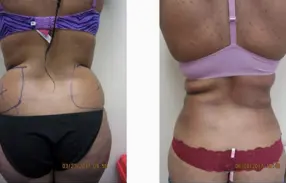 Liposuction Abdomen (women)