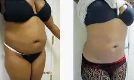 Liposuction Abdomen (women)