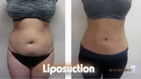 Liposuction Abdomen (women)