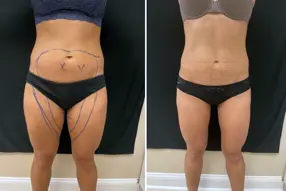 Abds and Inner thigh Liposuction Results Washington DC-Dr. Drew Varano