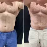Liposuction Male Results Washington DC- Medical Cosmetic Enhancements