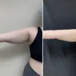 Arm Liposuction Results Washington DC, near Dupont Circle and Georgetown-Dr. Drew Varano